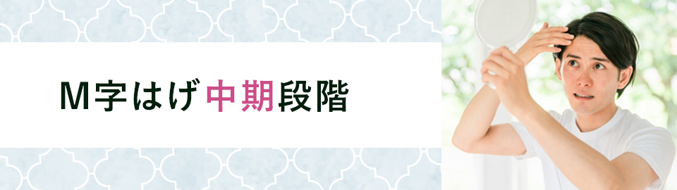 M字はげ中期段階