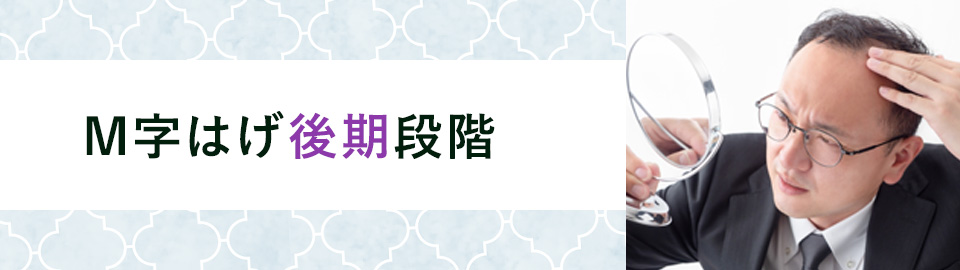 M字はげ後期段階