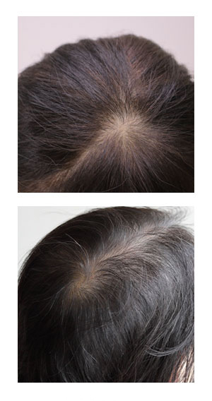 つむじはげ気味の写真