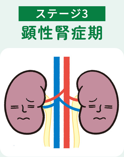 ステージ3顕性腎症期
