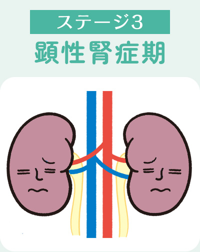 ステージ3顕性腎症期