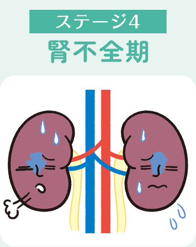 ステージ4腎不全期